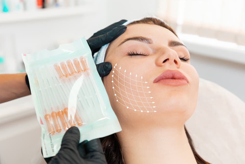 Patient receiving PDO thread lift at Ageless Health Institute with marked vectors showing lifting directions on the cheek during collagen-stimulating treatment